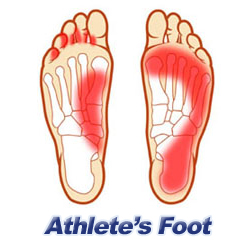 Athlete's Foot Diagram