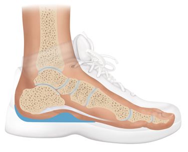 Fascia Bar Heel Pain Orthotic Insert