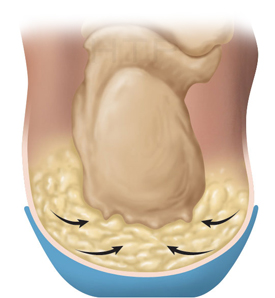 natural fat pad of the heel with orthotic support