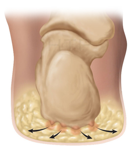 natural fat pad of the heel