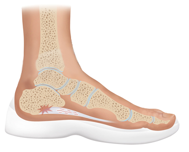 Heel pain and lack of fascia support