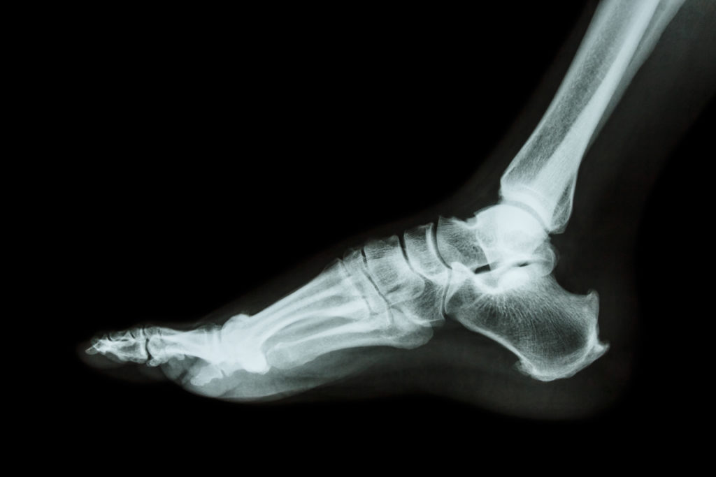 X-ray heel pain