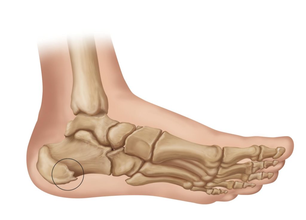 Heel Spurs Medical Illustration