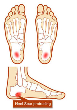 heel bone spur