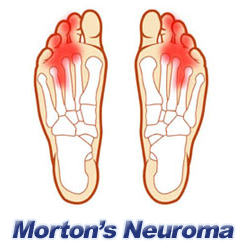 Morton's Neuroma Pain in the Foot