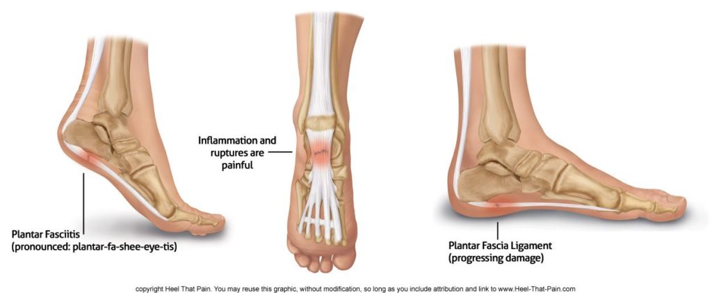 Plantar Fasciitis Medical Diagram
