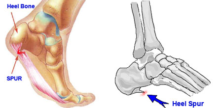 heel bone spurs