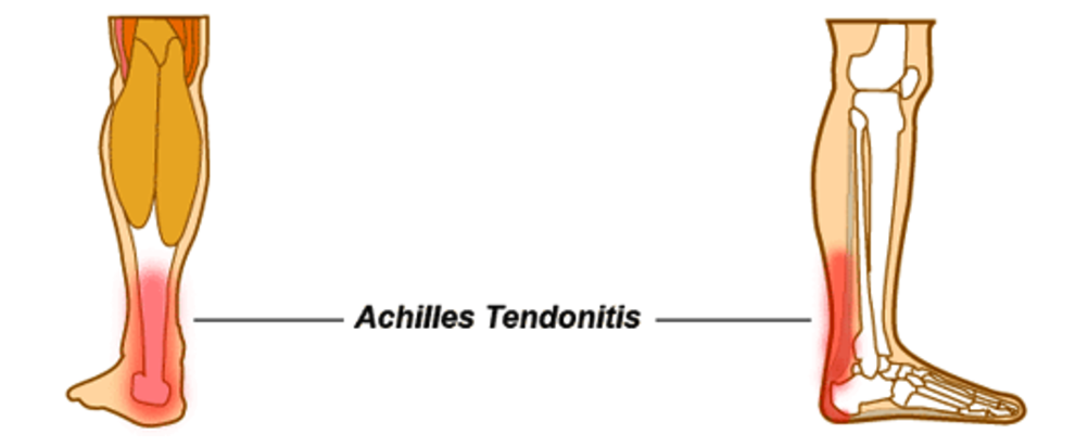 Achilles Tendinitis Illustration