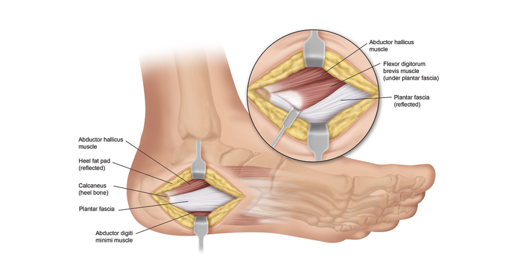 Plantar Fasciitis Surgery Illustration