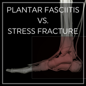 Plantar Fasciitis vs. Stress Fracture